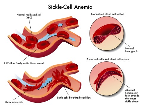 medical illustration of the effects of sickle cell anemia